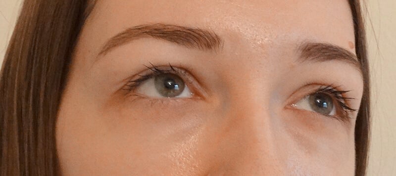 bioptic eye contour treatment 02