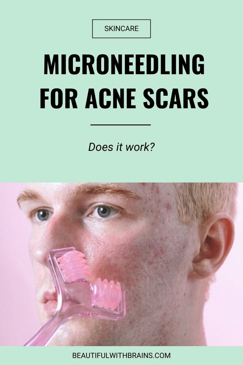 does microneedling work for acne scars