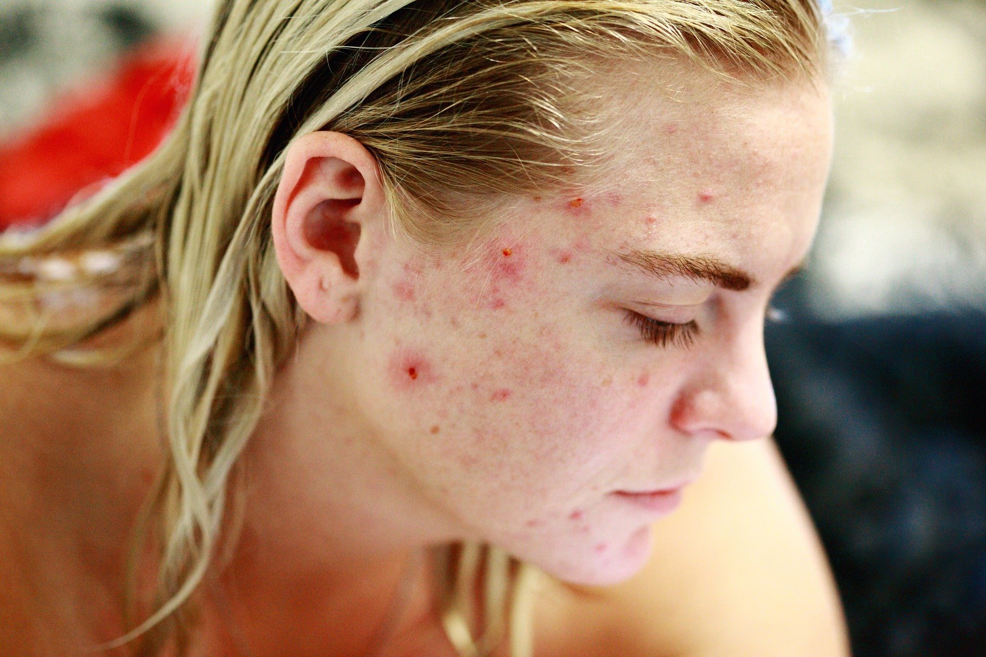 treat acne scars